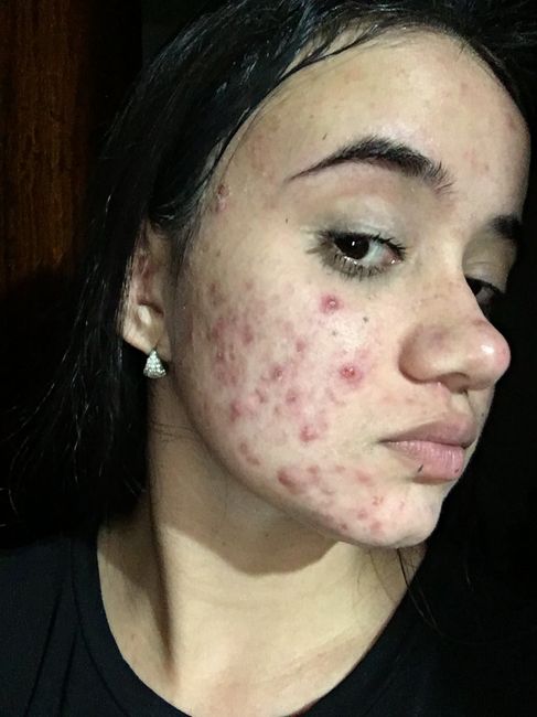 Tratamento contra acne 2