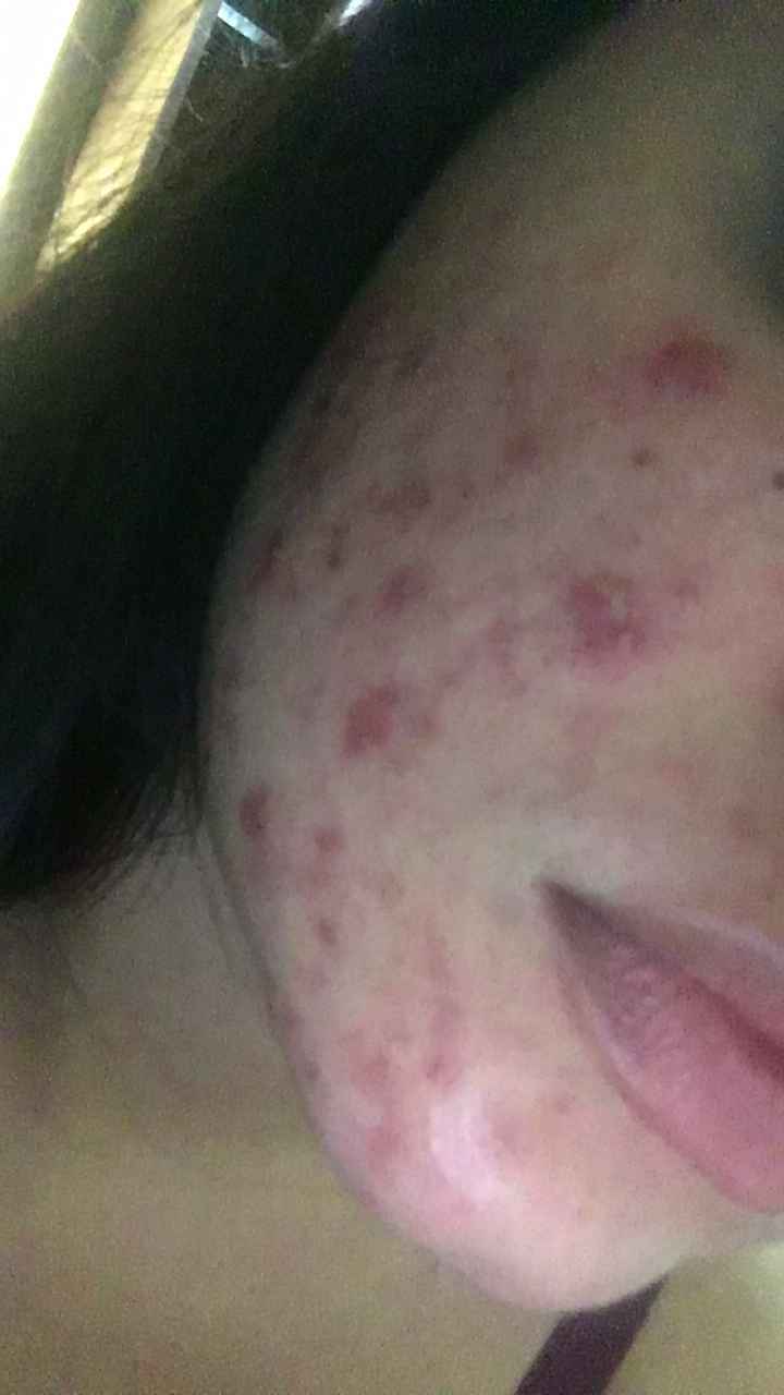 Tratamento contra acne - 1