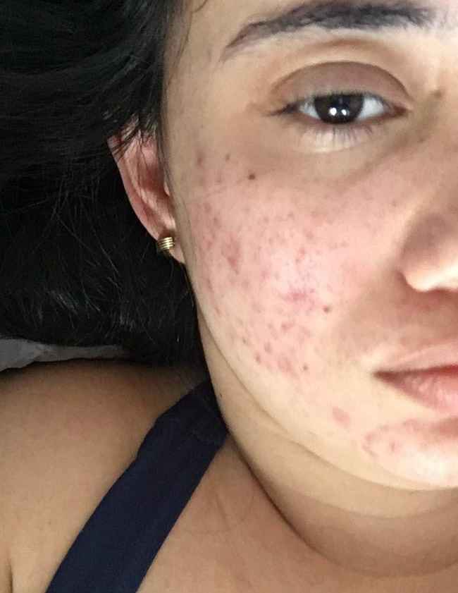Tratamento contra acne - 2