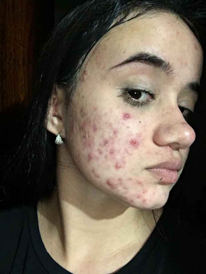 Tratamento contra acne - 3