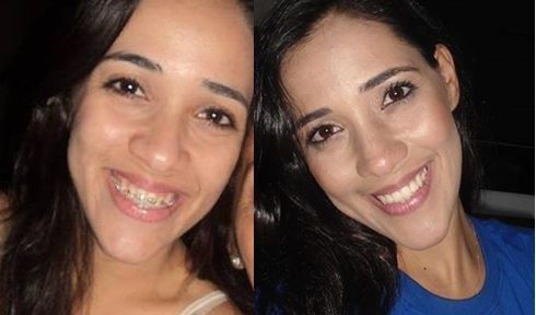 Caso com ou Sem aparelho ?