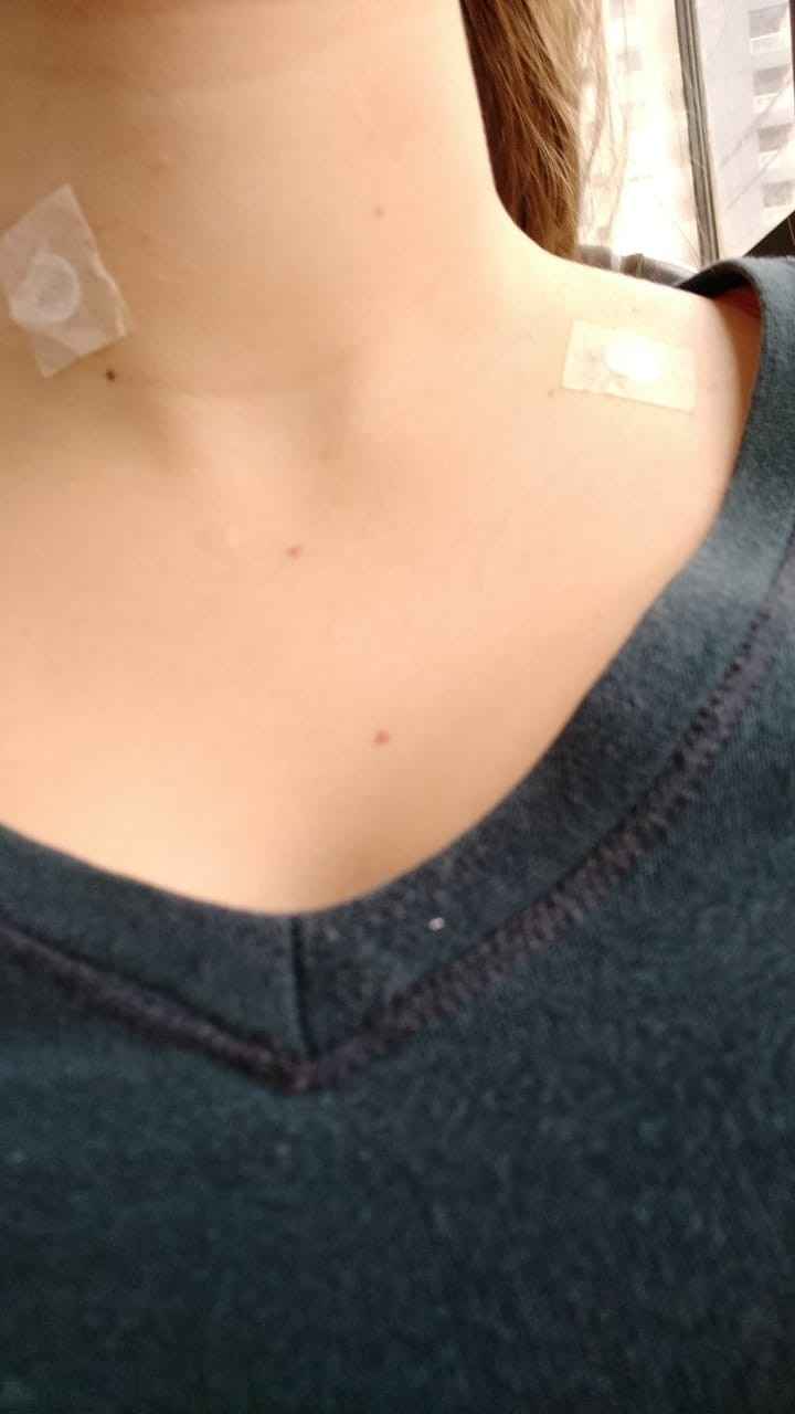 após a remoção