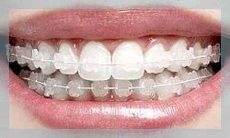 Aparelho odontologia estético  - 1