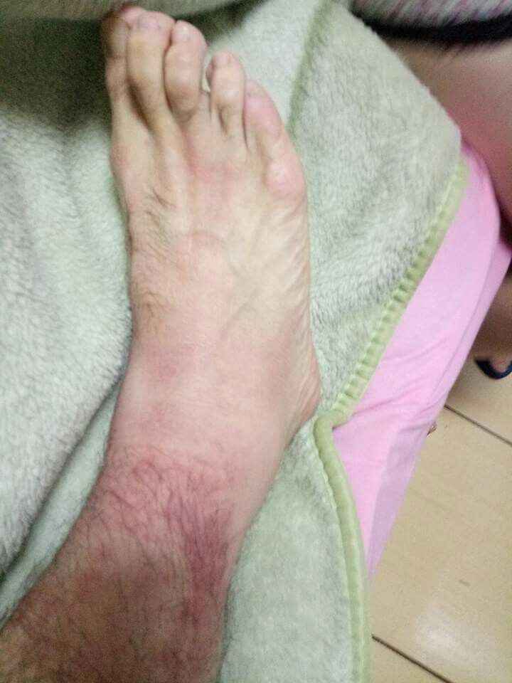 Sufoco esse domingo alergia alimentar. - 2