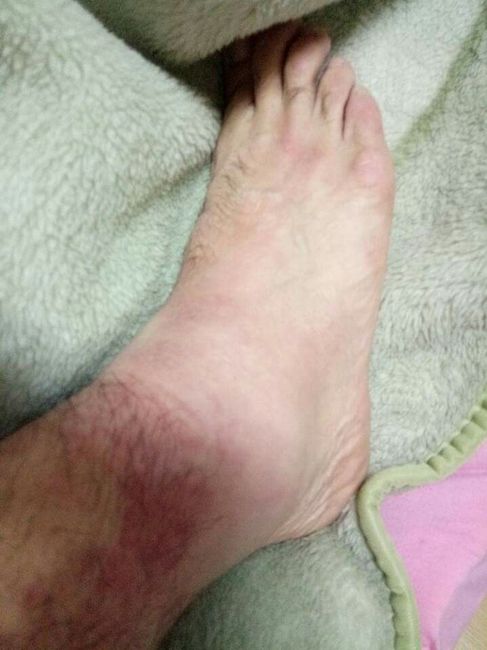 Sufoco esse domingo alergia alimentar. - 3