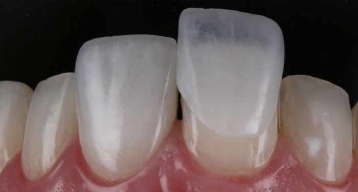 Lentes de contato dental. Você colocaria para o dia C? 2
