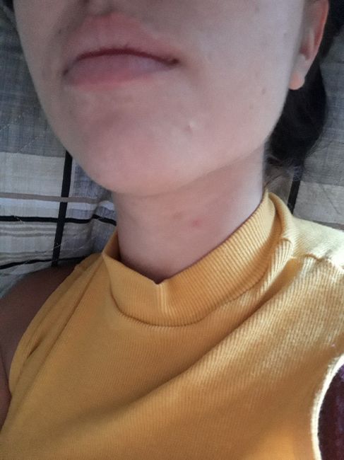 Acne da mulher adulta 😧 5