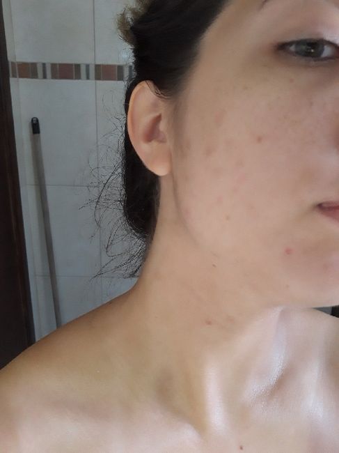 Acne da mulher adulta 😧 7