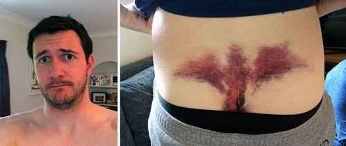 Hematoma