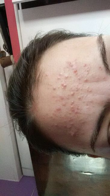 Acnes por estresse....socorroooooo!!! - 1