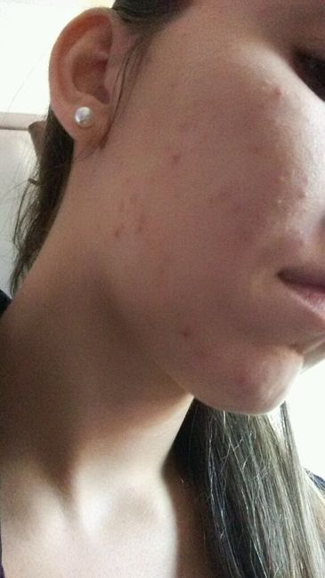 Acnes por estresse....socorroooooo!!! - 2