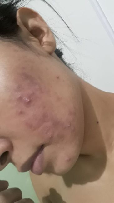 Acne da mulher adulta 😧 9