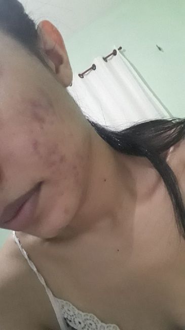 Acne da mulher adulta 😧 10