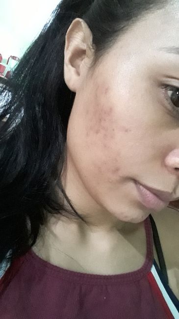 Minha experiência com acne, anticoncepcional e casamento (com Fotos) 2