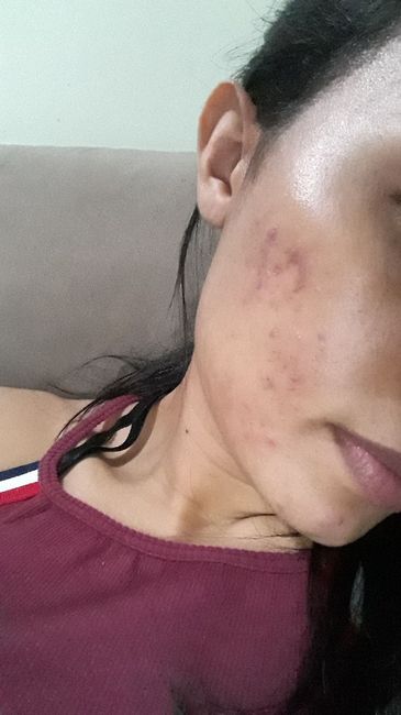 Minha experiência com acne, anticoncepcional e casamento (com Fotos) 3