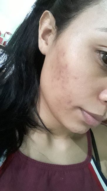 Minha experiência com acne, anticoncepcional e casamento (com Fotos) 1