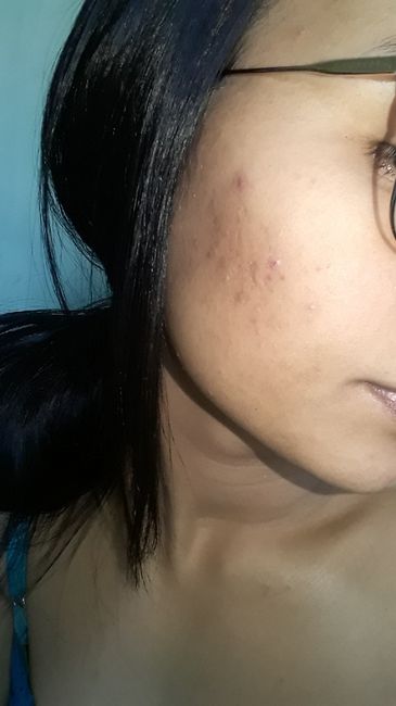 Minha experiência com acne, anticoncepcional e casamento (com Fotos) 12