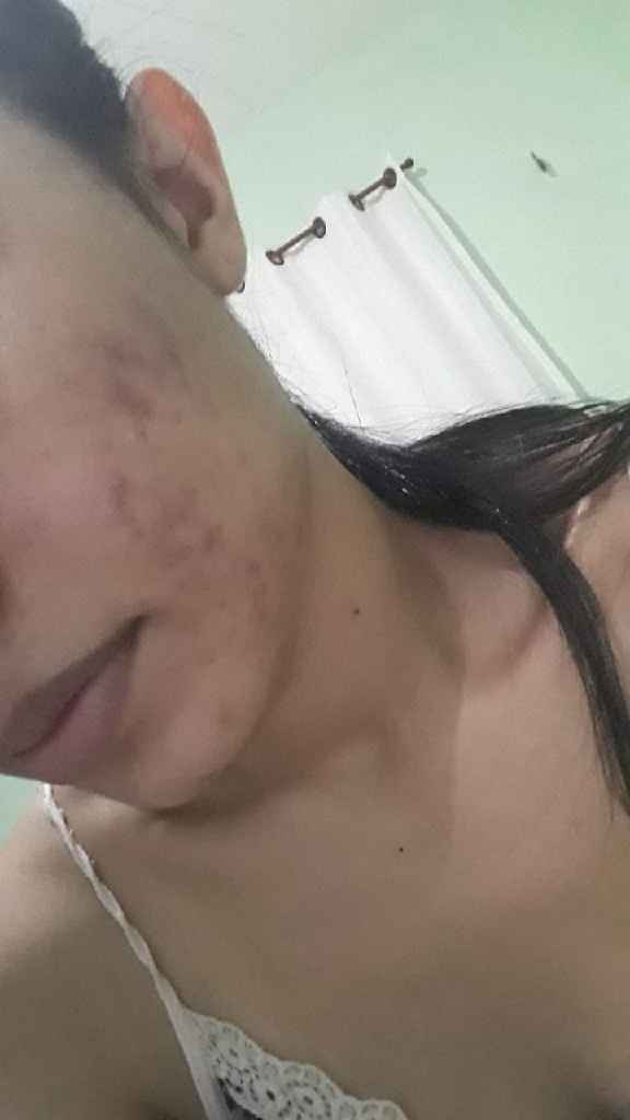 Acne da mulher adulta 😧 - 2