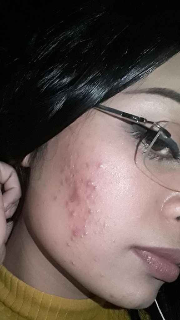 Minha experiência com acne, anticoncepcional e casamento (com Fotos) - 2