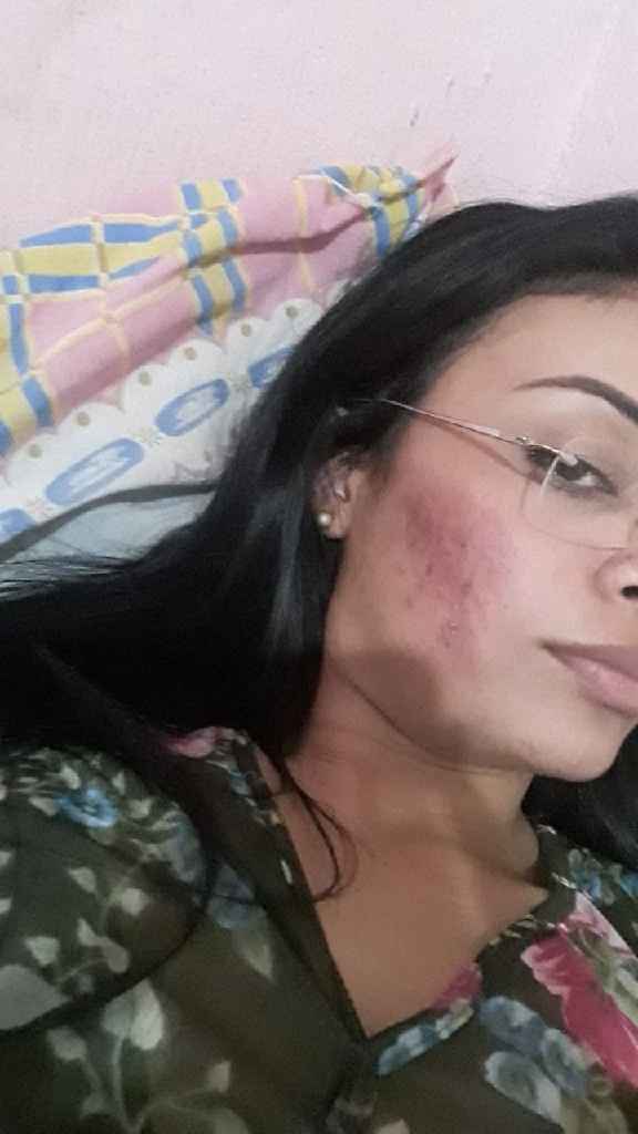 Minha experiência com acne, anticoncepcional e casamento (com Fotos) - 3