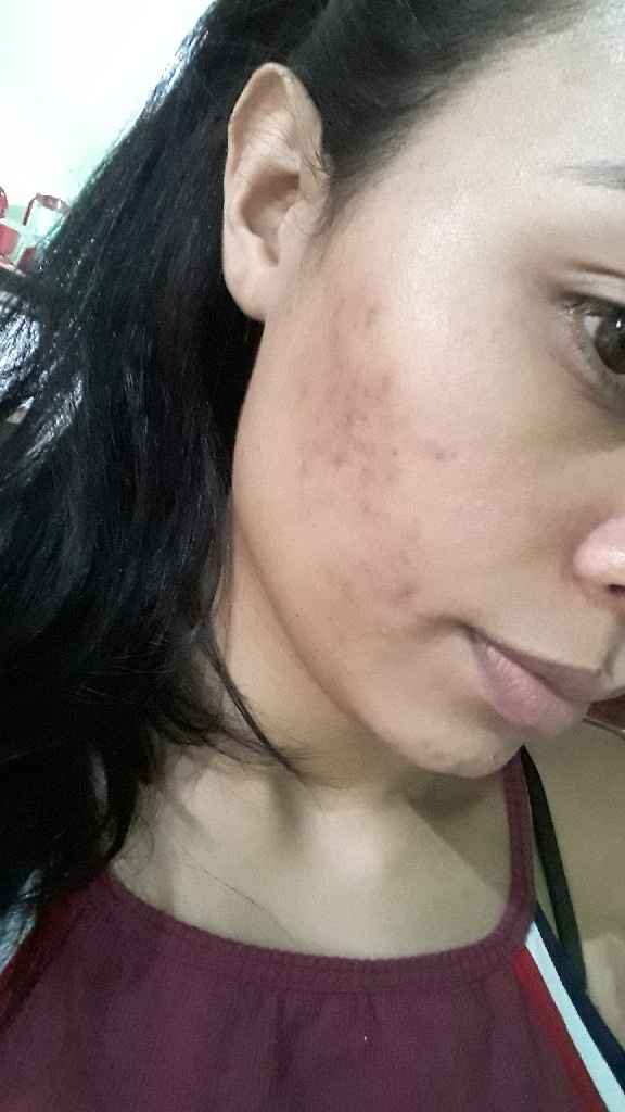 Minha experiência com acne, anticoncepcional e casamento (com Fotos) - 1