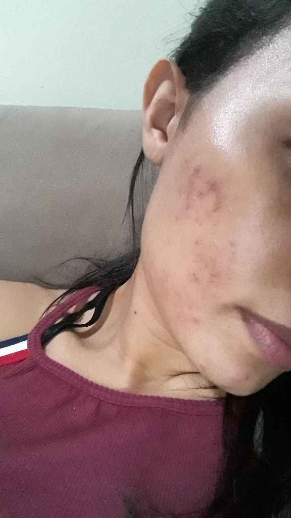 Minha experiência com acne, anticoncepcional e casamento (com Fotos) - 2