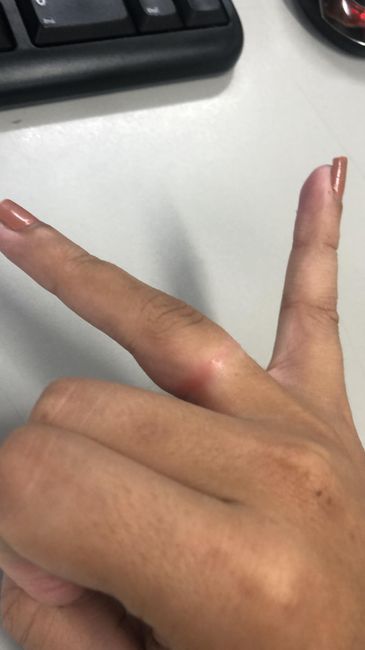 Mais alguém com esse probleminha?? 😣 - 1