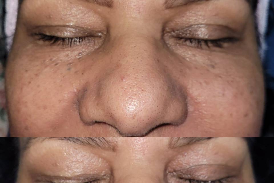 Limpeza de pele feminina