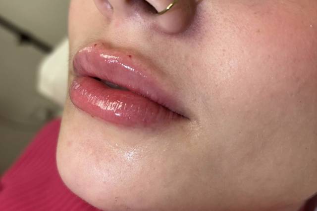 Preenchimento labial
