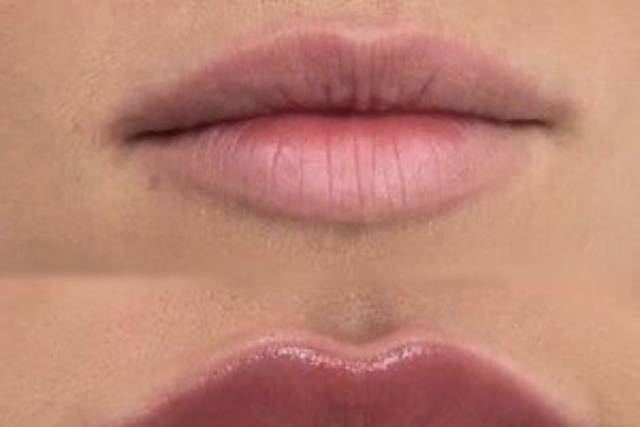 Preenchimento labial