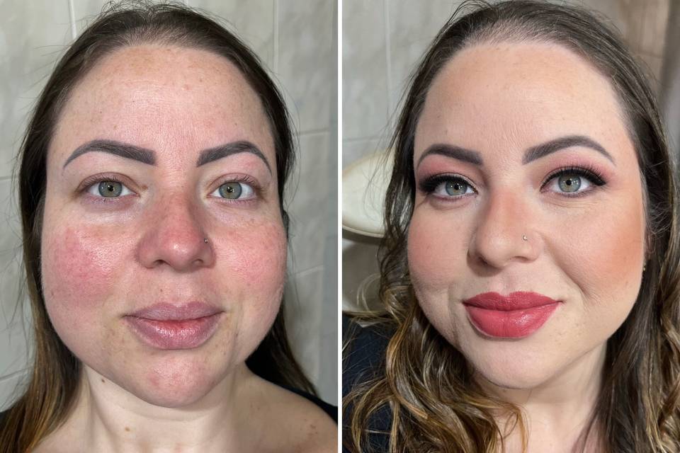 Pele com acne