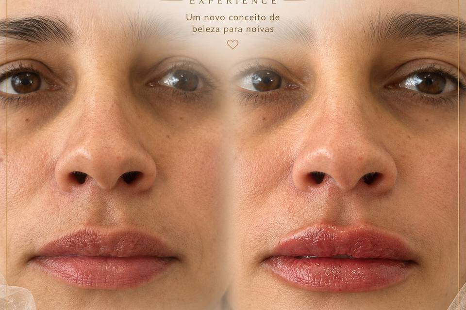 Preenchimento Labial