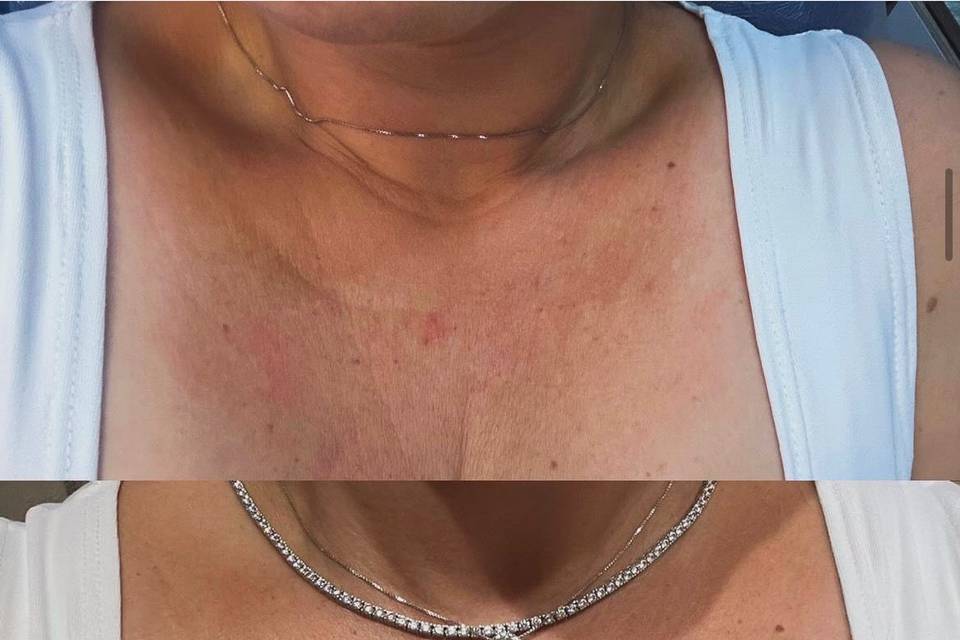 Botox no colo