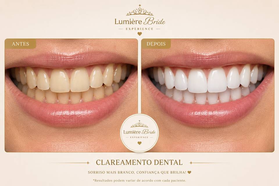 Dentes branquinhos