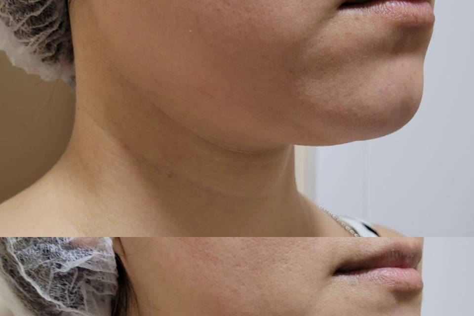 Contorno facial