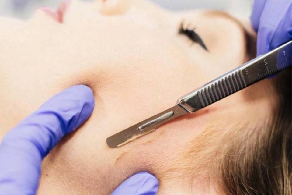 Dermaplaning