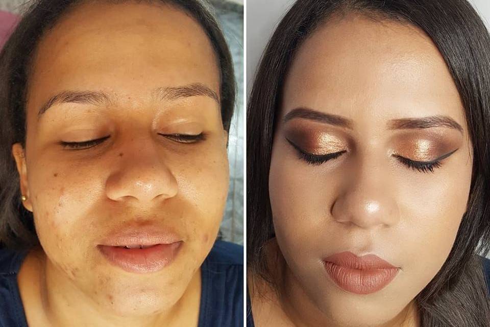 Antes e Depois, pele com acne