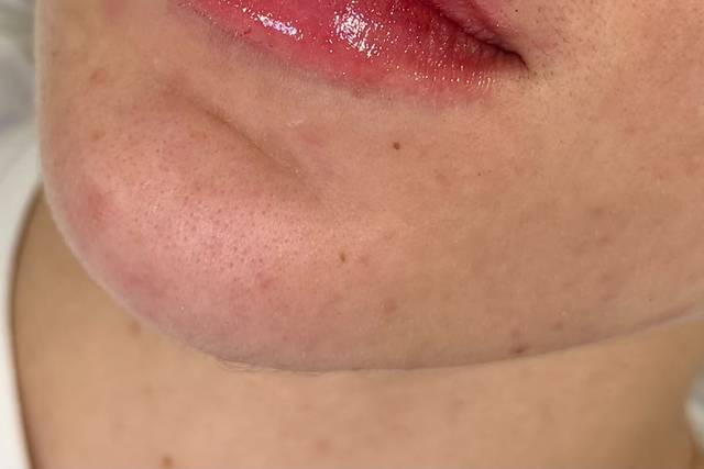 Preenchimento Labial
