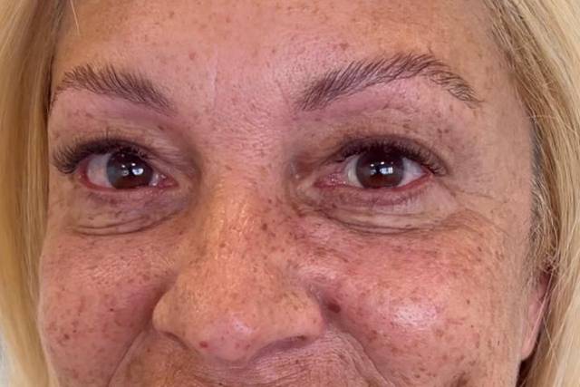 Botox