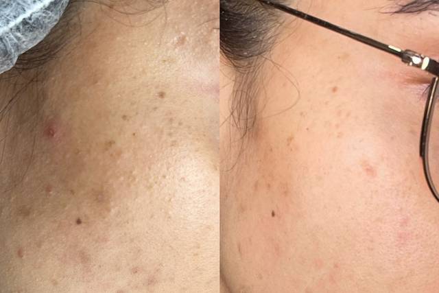 Peeling do Mar Morto