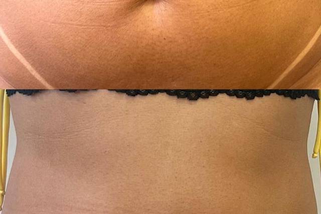 Flacidez Facial e Corporal