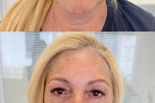 Botox