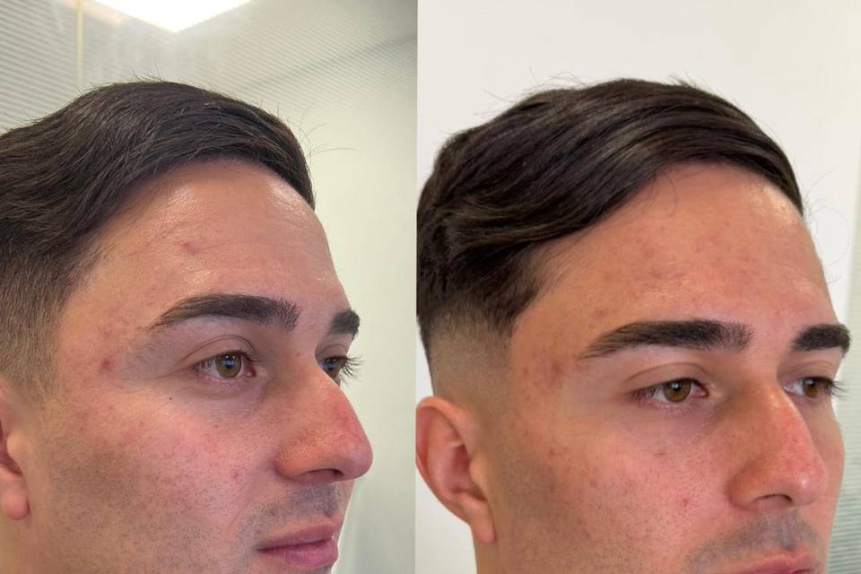 Harmonização Facial