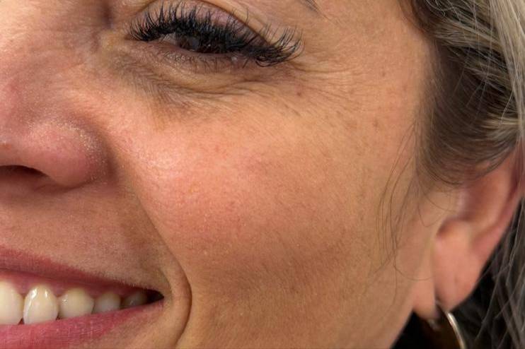 Botox