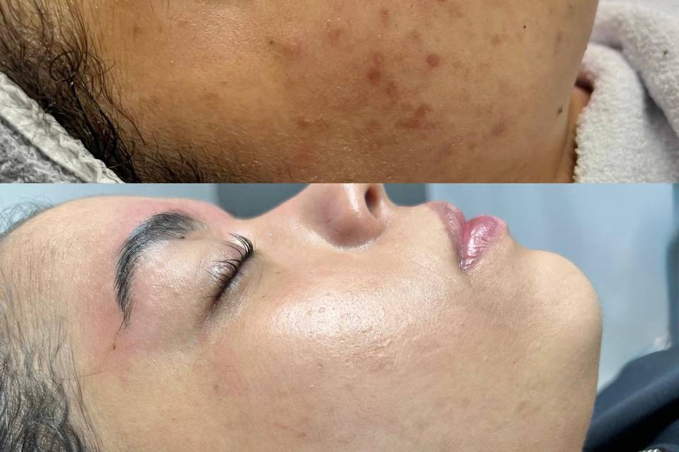 Tratamento de Acne e Cicatrize