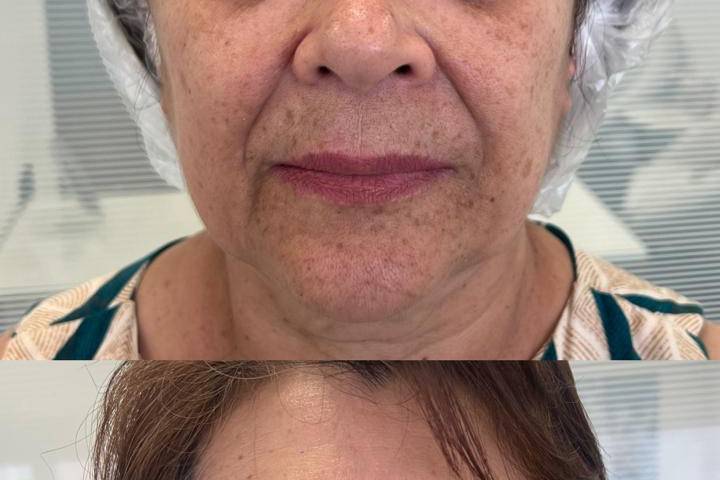 Manchas e Melasma
