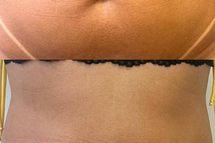 Flacidez Facial e Corporal